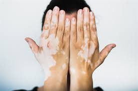Vitiligo hastaları çareyi Bursa’da buluyor