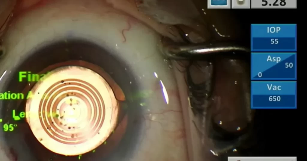 Canlı yayında göz ameliyatı yaptılar